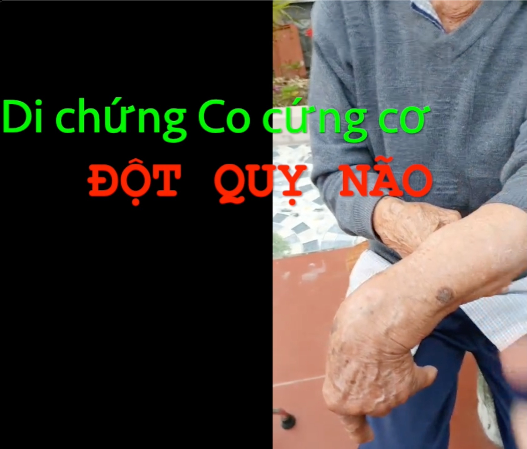 Thiếu cơ sở phục hồi chức năng sau Đột quỵ não?