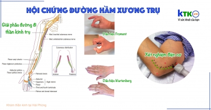 Hội chứng đường hầm xương trụ - teo cơ dọc mặt trong cẳng tay.